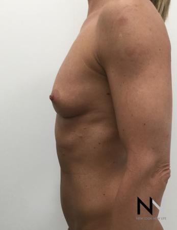 Breast Augmentation: Patient 3 - Before Image 2