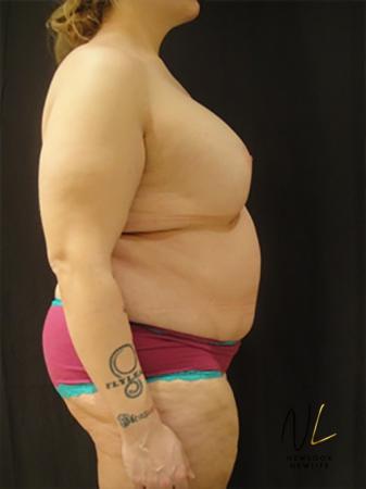 Abdominoplasty: Patient 16 - After Image 3