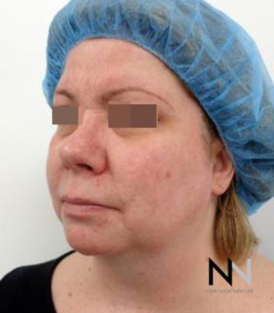 Fractional Resurfacing: Patient 2 - After Image 3