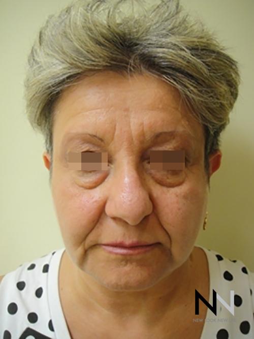 Liquid Facelift: Patient 3 - Before 