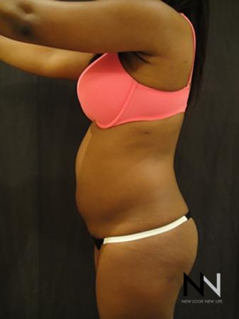 Liposuction: Patient 4 - Before Image 2