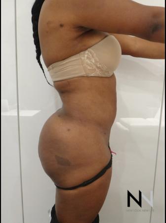 Butt Augmentation: Patient 4 - After Image 3