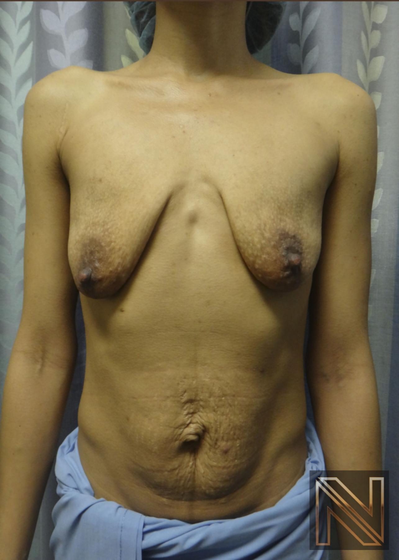 Breast Lift: Patient 4 - Before 