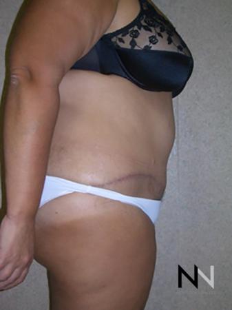 Abdominoplasty: Patient 4 - After Image 3