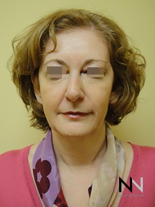 Liquid Facelift: Patient 2 - After 1