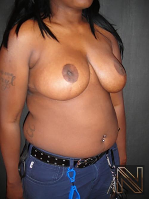 Breast Reduction: Patient 6 - After 3