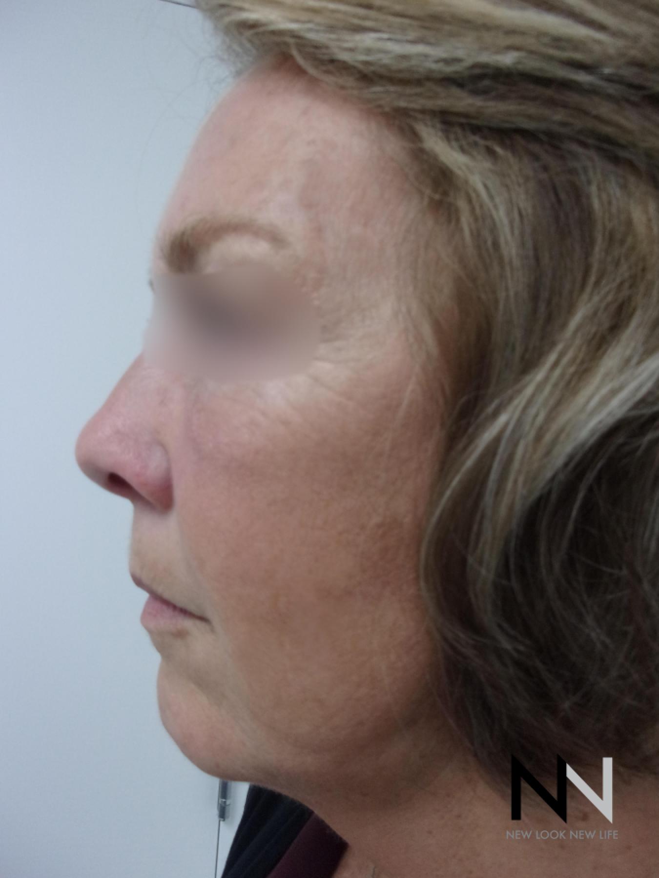 Laser Skin Resurfacing - Face: Patient 1 - After 2