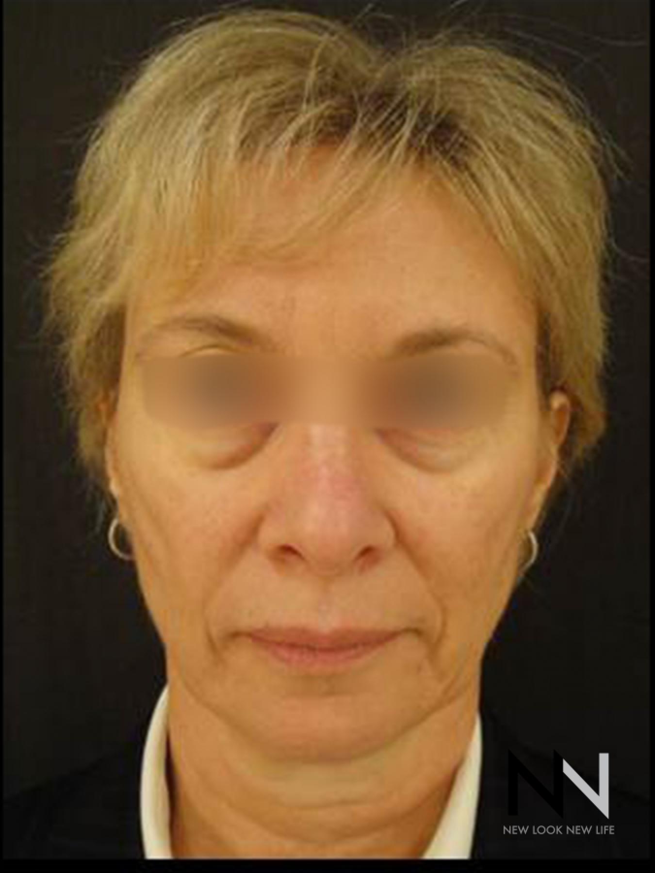 Liquid Facelift: Patient 6 - Before 1