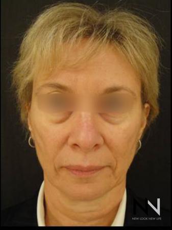 Liquid Facelift: Patient 6 - Before Image 1