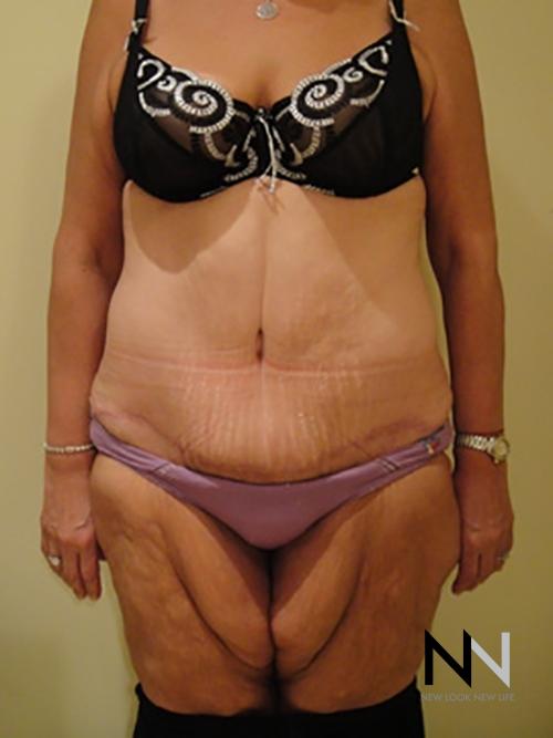 Abdominoplasty: Patient 3 - After  