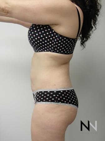Liposuction: Patient 5 - After Image 2