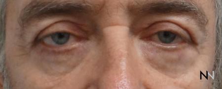Blepharoplasty: Patient 7 - After Image 3