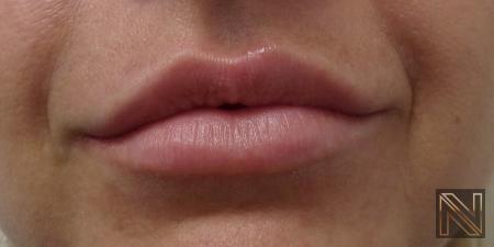 Fillers: Patient 4 - After  