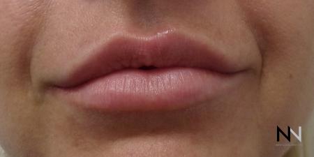 Fillers: Patient 4 - After 1