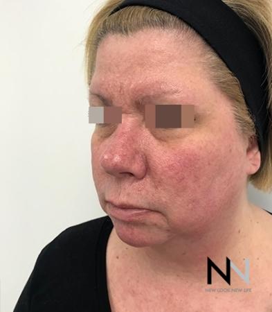 Fractional Resurfacing: Patient 2 - Before Image 3