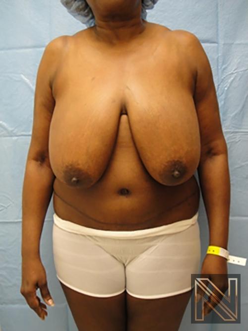 Breast Reduction: Patient 4 - Before 1