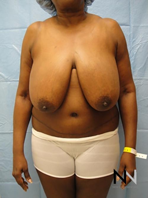 Breast Reduction: Patient 4 - Before 