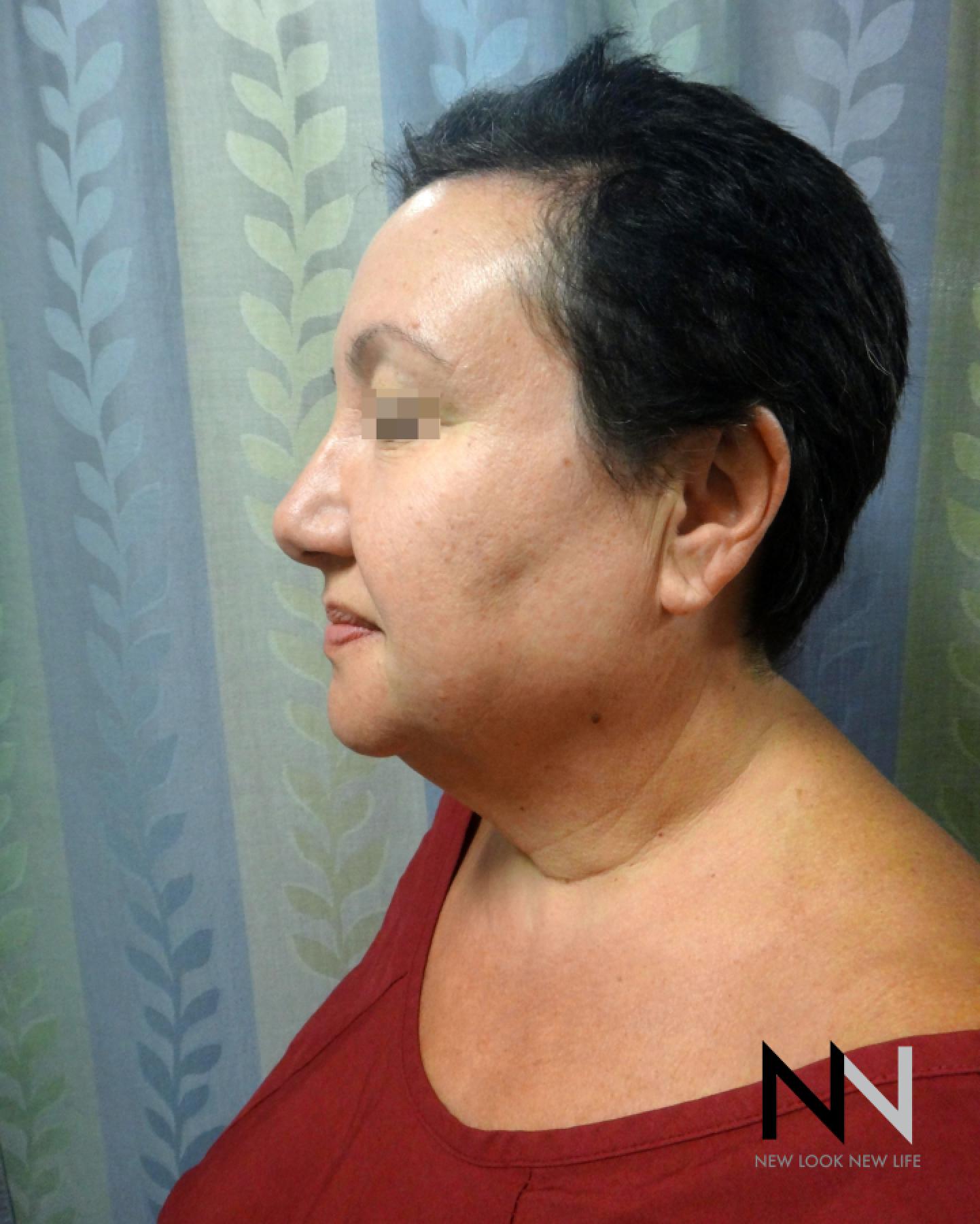 Facelift/Mini Facelift: Patient 6 - Before 1