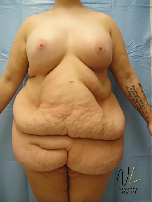 Abdominoplasty: Patient 16 - Before 1