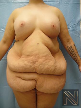 Abdominoplasty: Patient 16 - Before 1