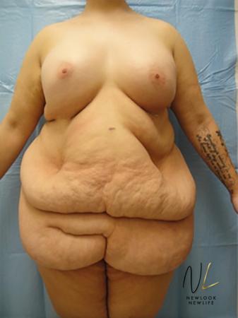 Abdominoplasty: Patient 16 - Before Image 1