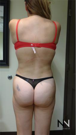 Butt Augmentation: Patient 3 - After Image 2