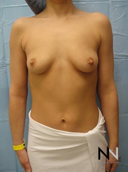 Breast Augmentation: Patient 10 - Before 