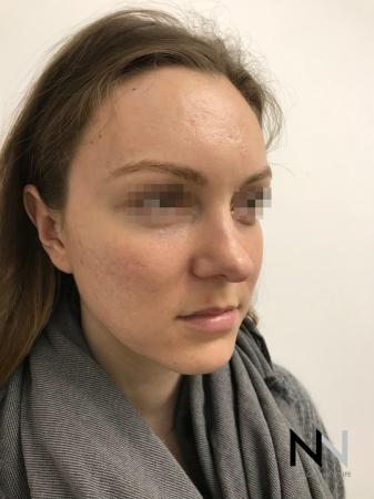 Fractional Resurfacing: Patient 4 - After Image 4