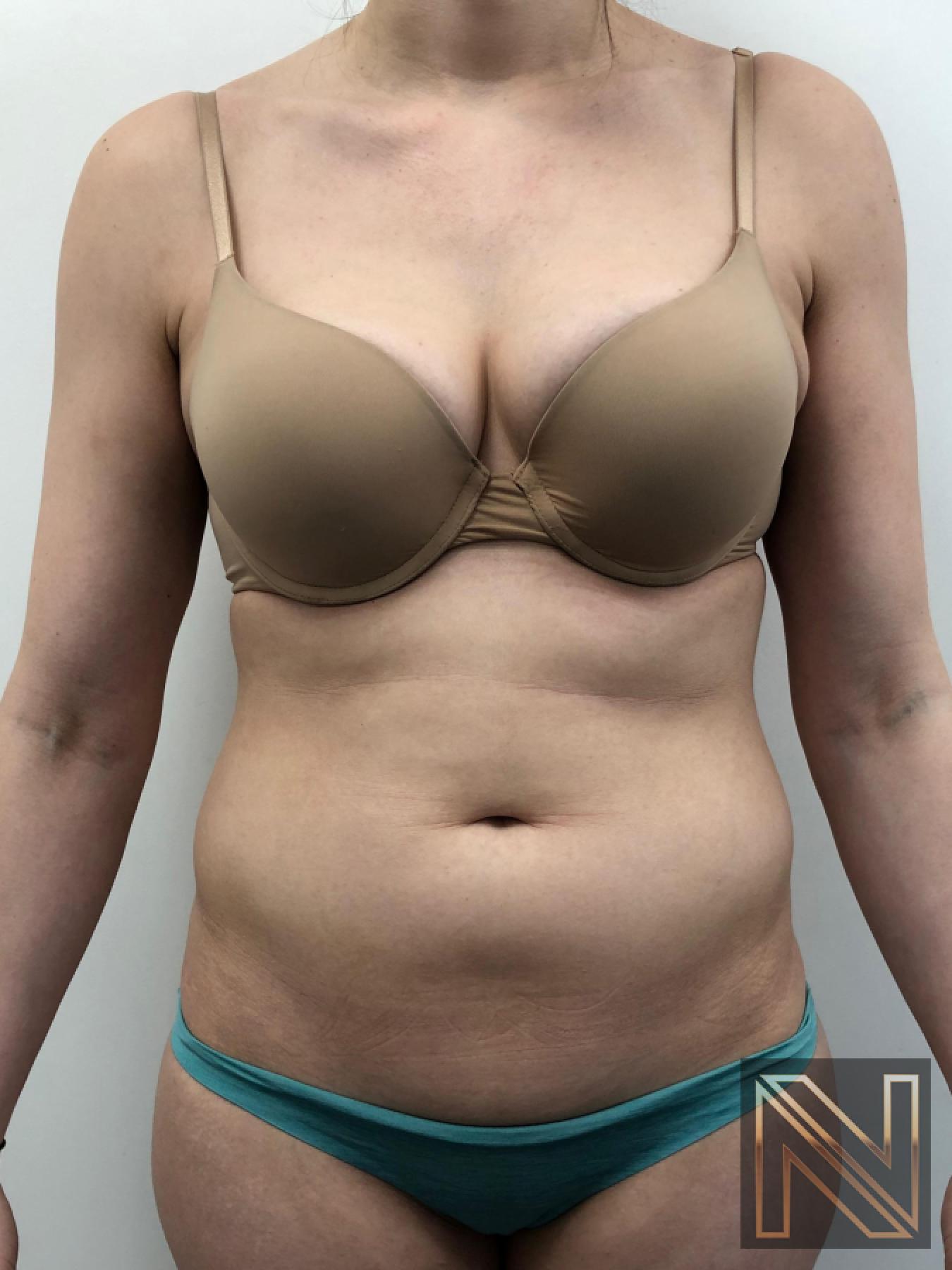 Liposuction: Patient 10 - Before 1