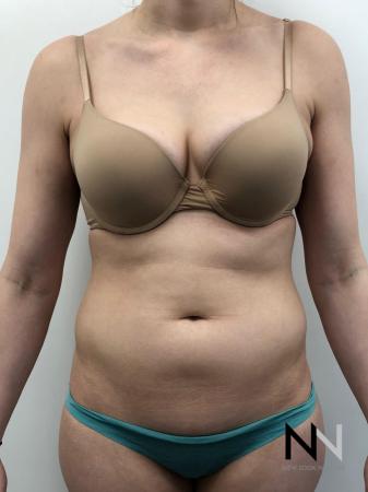 Liposuction: Patient 10 - Before Image 1