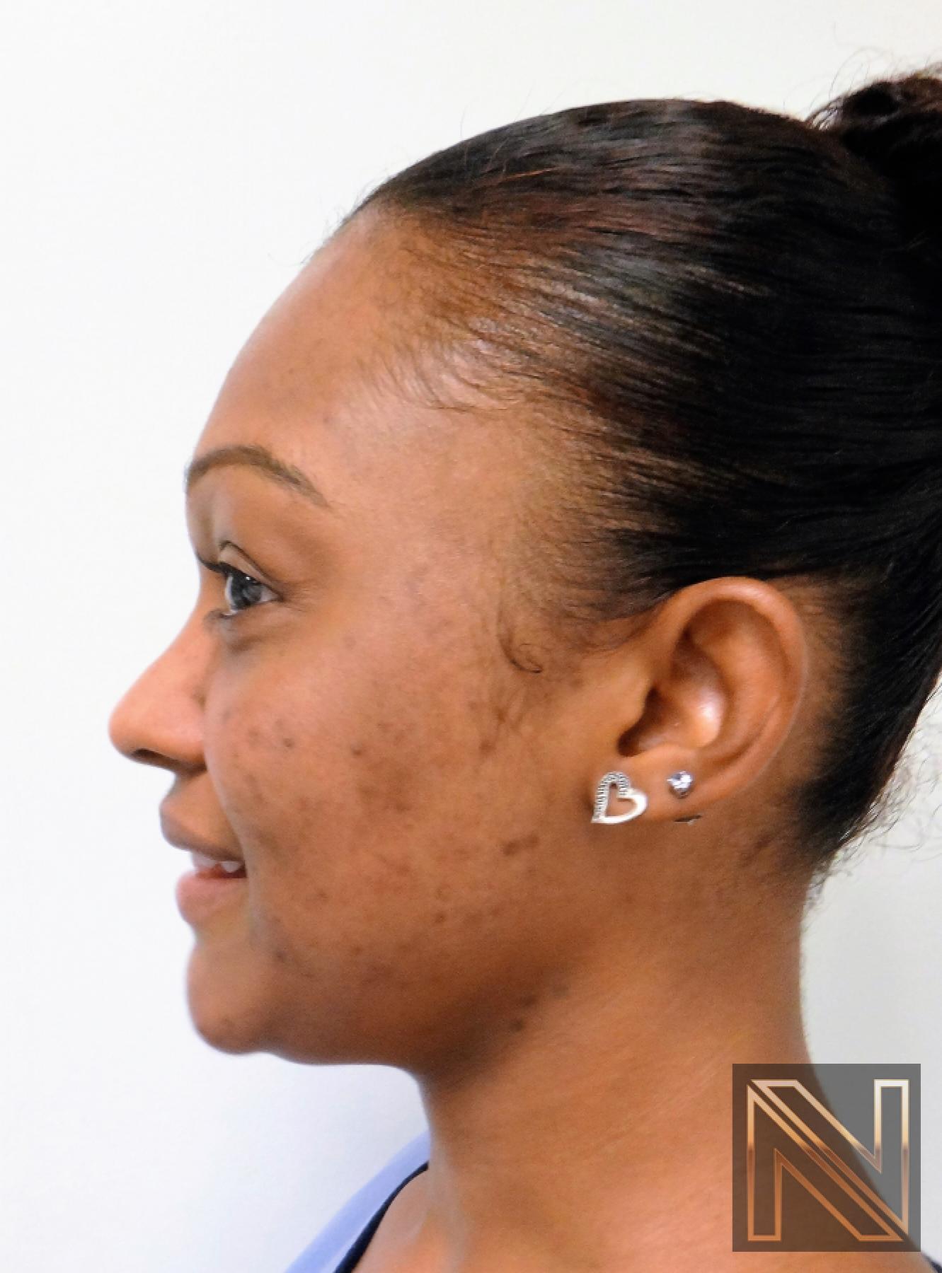 Laser Skin Resurfacing - Face: Patient 4 - After 3