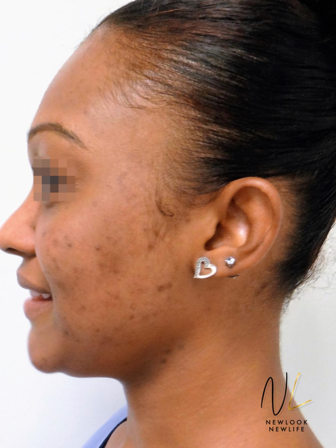 Laser Skin Resurfacing - Face: Patient 4 - After 3