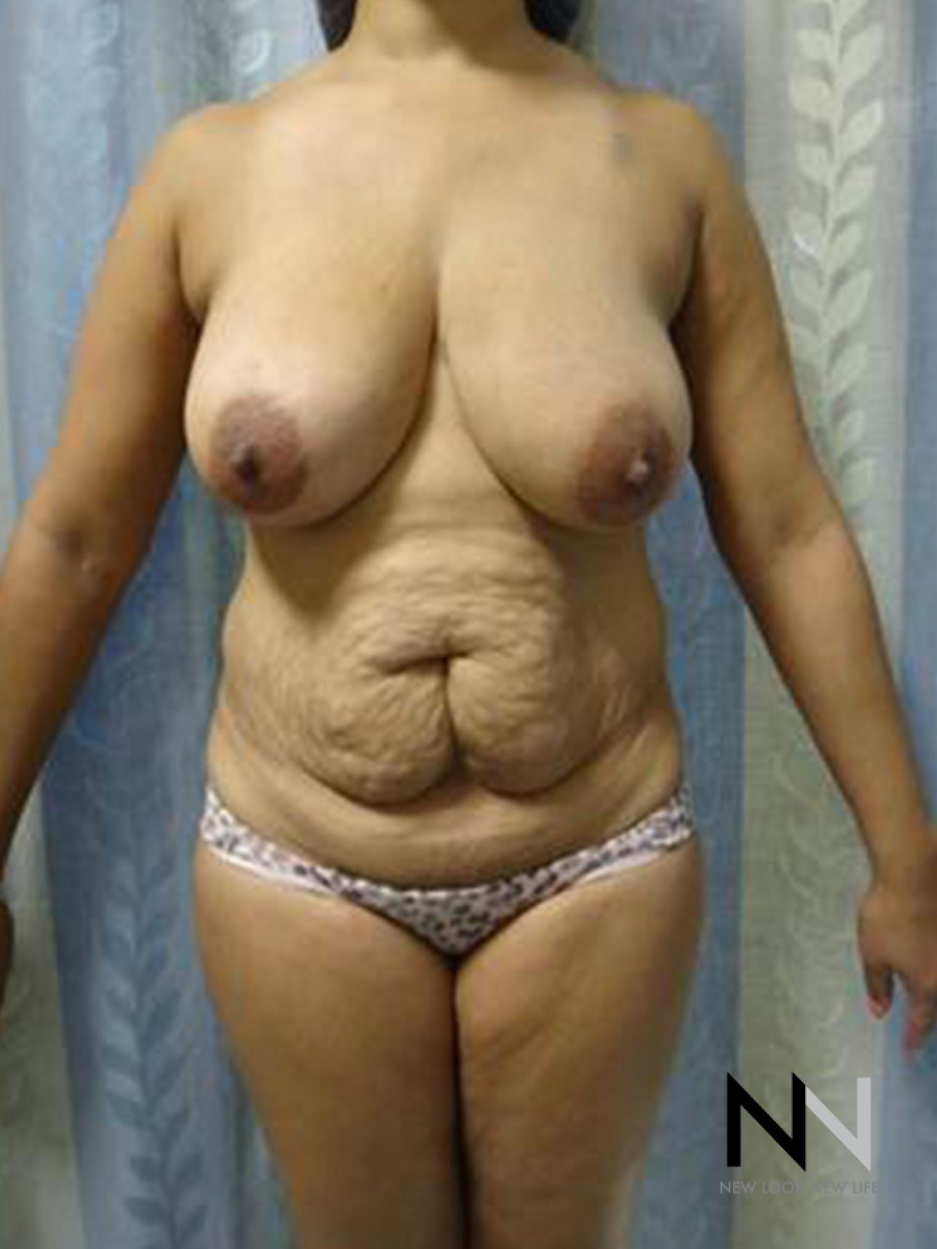 Abdominoplasty: Patient 25 - Before 1