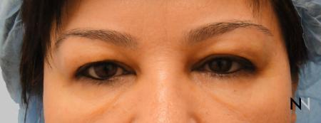 Blepharoplasty: Patient 5 - Before Image 1