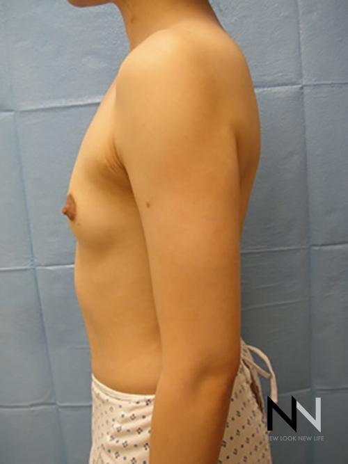 Breast Augmentation: Patient 4 - Before 4