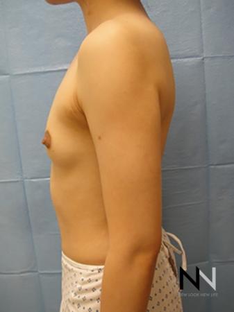 Breast Augmentation: Patient 4 - Before Image 4