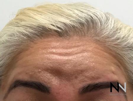 Dysport® : Patient 1 - Before Image 1