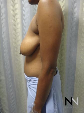 Breast Lift: Patient 2 - Before Image 3