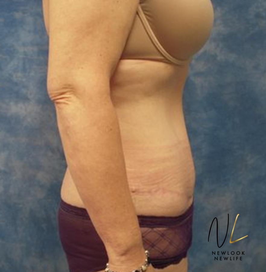 Abdominoplasty: Patient 30 - After 2