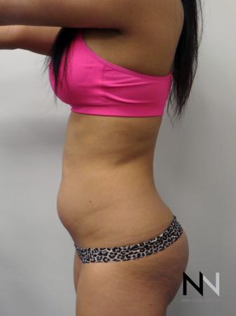 Liposuction: Patient 9 - Before Image 3