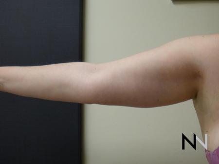Liposuction: Patient 24 - After Image 2