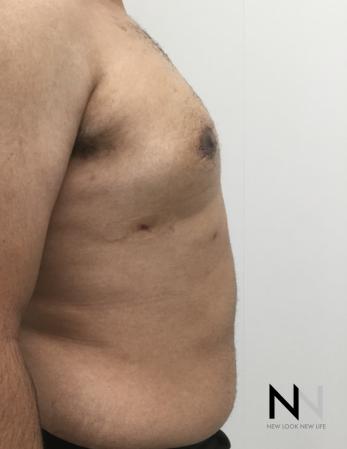 Gynecomastia: Patient 10 - After Image 3