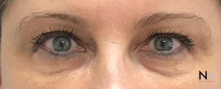 Fillers: Patient 15 - After Image 1