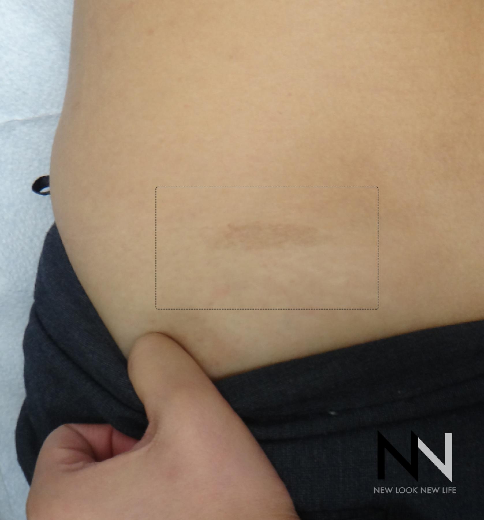 Fractional Resurfacing: Patient 8 - Before 