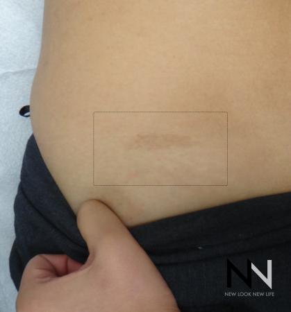 Fractional Resurfacing: Patient 8 - Before Image 1