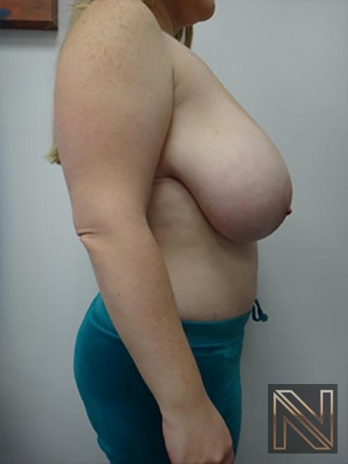 Breast Reduction: Patient 9 - Before and After 5