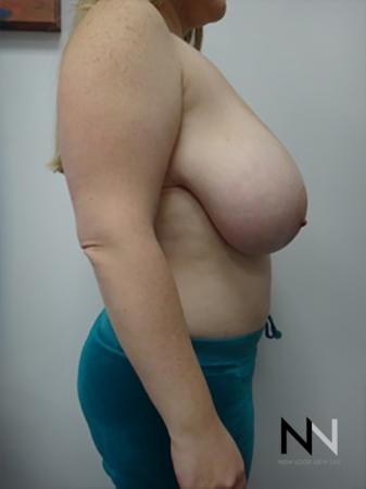 Breast Reduction: Patient 9 - Before and After Image 5
