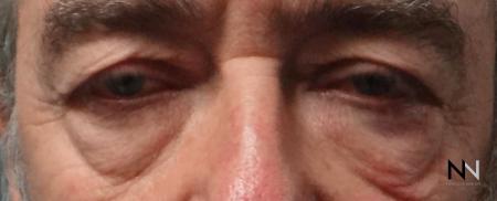 Blepharoplasty: Patient 7 - Before and After Image 3