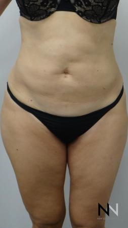 Liposuction: Patient 12 - After Image