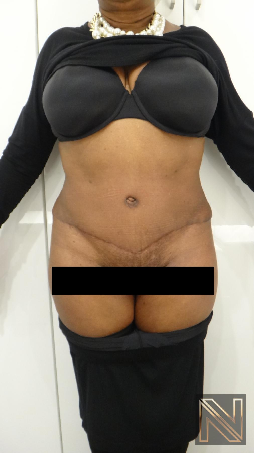 Abdominoplasty: Patient 22 - After 1